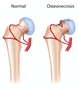 Avasculaire necrose van de humeruskop