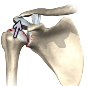 Opstijging van de schouderkop bij rotator cuff arthropathie