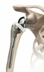 Omgekeerde schouderprothese op radiografie