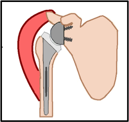 Deltoidspier als motor van de omgekeerde schouderprothese