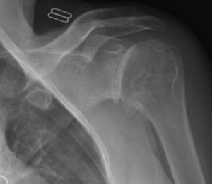 Anatomische schouderprothese schema