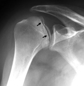 Anatomische schouderprothese componenten