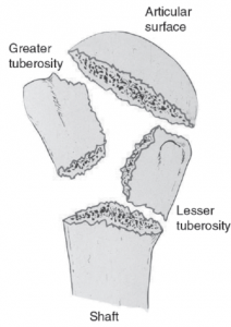 Fractuur schouderprothese