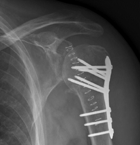 Radiografie fractuur schouderprothese