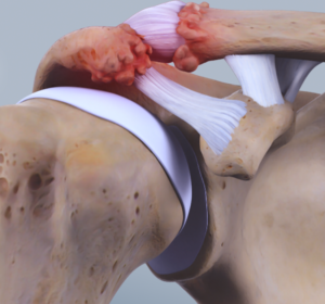 AC-gewricht met arthrose - kraakbeenslijtage