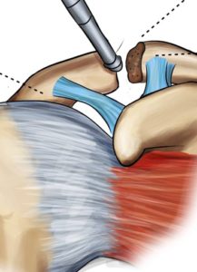 Arthroscopische AC-gewricht resectie