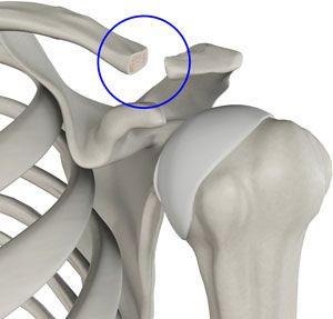 Distale clavicula excisie bij AC-artrose