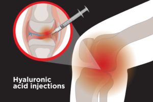 Injection d'acide hyaluronique dans l'articulation pour l'arthrose