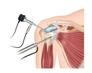 إطلاق المحفظة بالمنظار في الكتف المتجمد