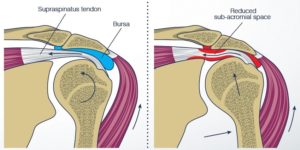 Tendon sıkışması ile omuz sıkışmasının diyagramı