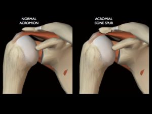 Anatomik görüntüde görülebilen akromiyondaki kemik çıkıntısı