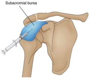 Omuz subakromiyal boşluğunda kortizon infiltrasyonu