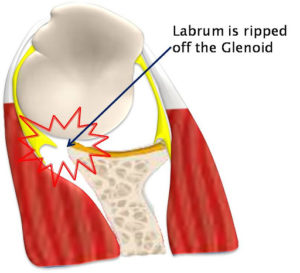 Labrum yırtığıyla Bankart yaralanmasının çizimi