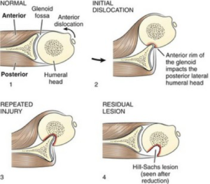 Humerus başında girintili Hill-Sachs yaralanması