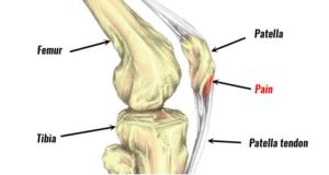 Jumper'ın dizindeki patellar tendonun anatomisi