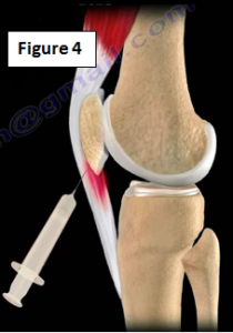 Patellar tendinit için infiltrasyon tedavisi