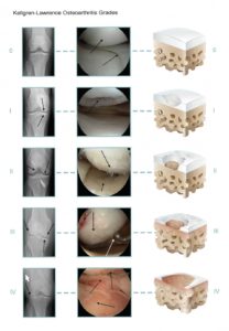 تصنيف تلف الغضروف - الارتباط بالأشعة السينية وتنظير المفاصل