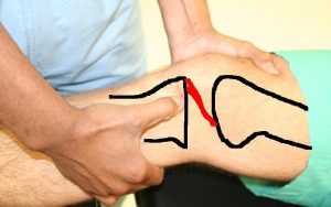 اختبار لاكمان لتشخيص إصابة الرباط الصليبي