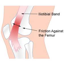 Dizin dış tarafındaki iliotibial bandın anatomisi