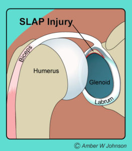 تصنيف إصابات SLAP من النوع الأول إلى الرابع
